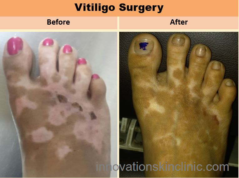 Vitiligo Surgery 4